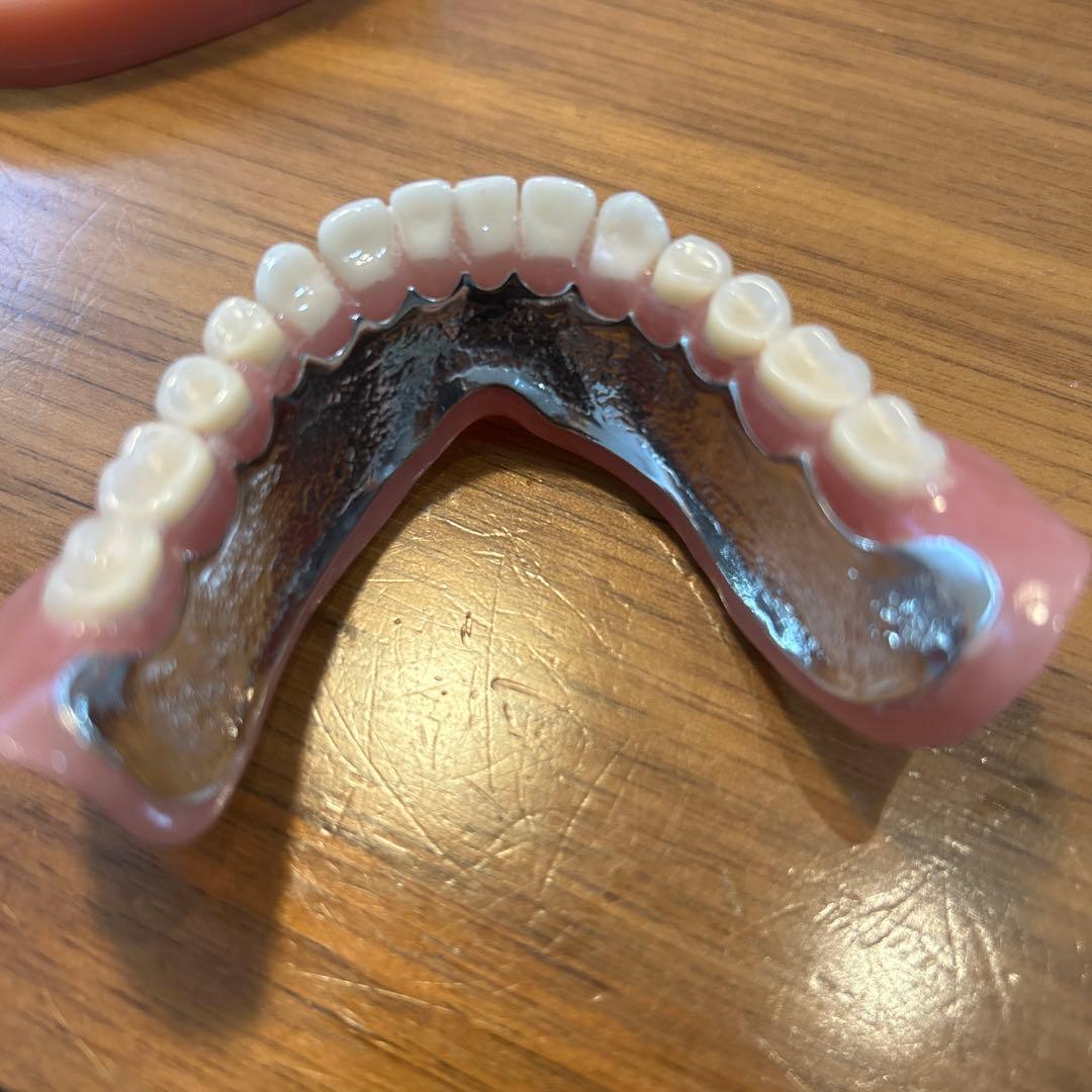 歯科サンプル　金属床義歯　模型付き　歯科医院