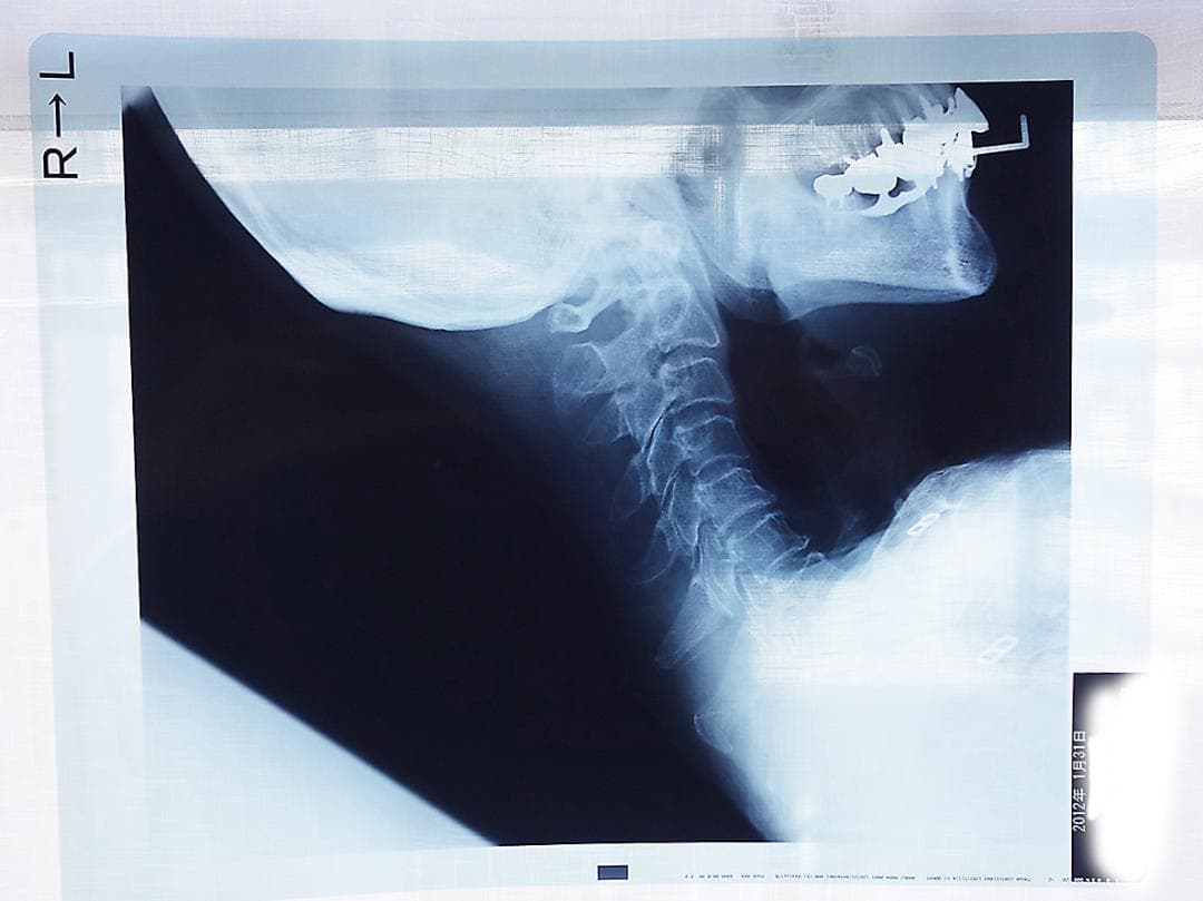 レントゲン写真　X線写真　　Z97