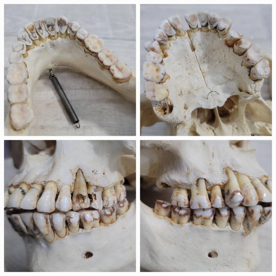 頭蓋骨 頭骨 骨格標本 人体模型 医療 医学 人類学 民俗学 アンティーク 呪物